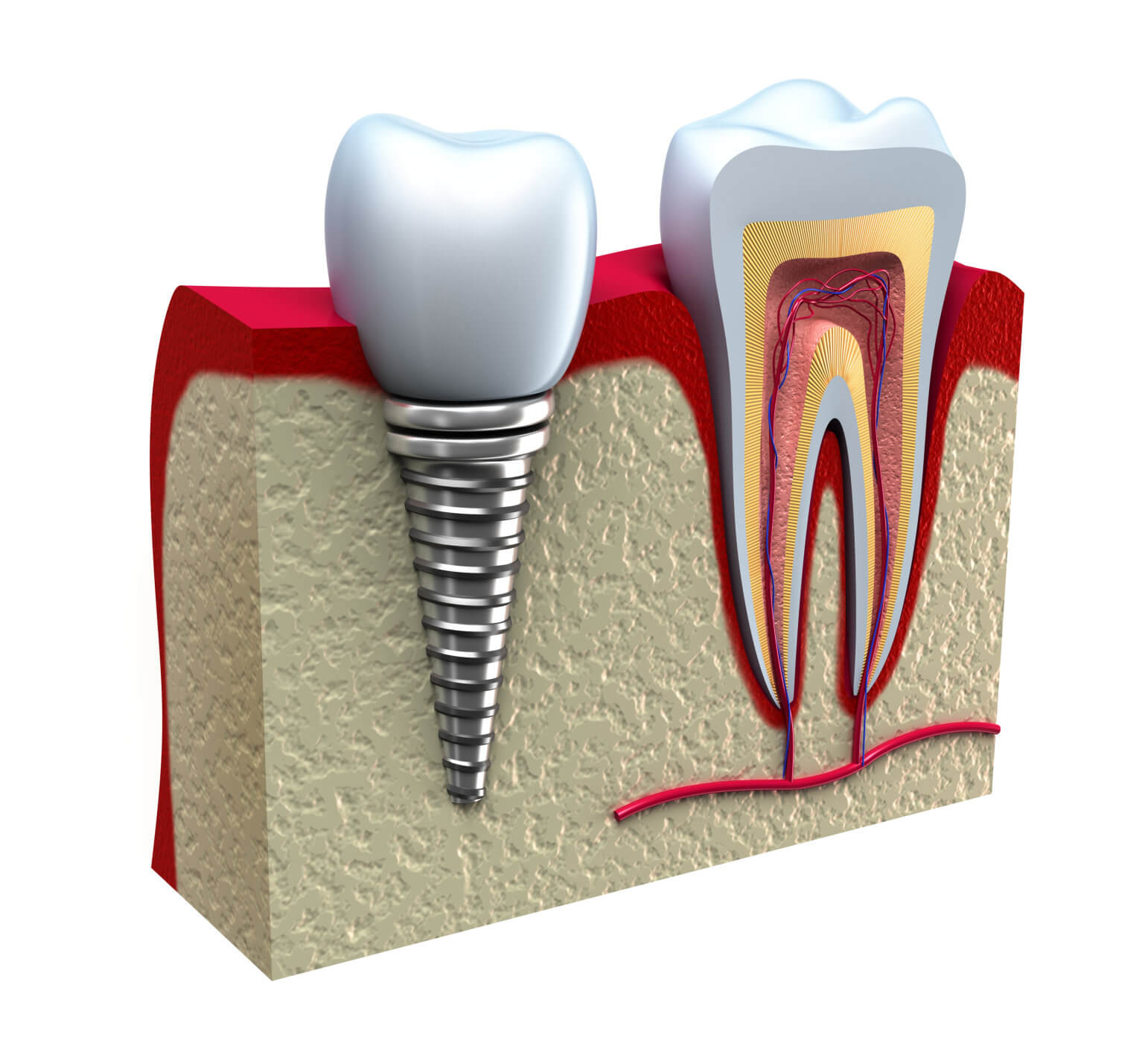 Downtown dental, implants