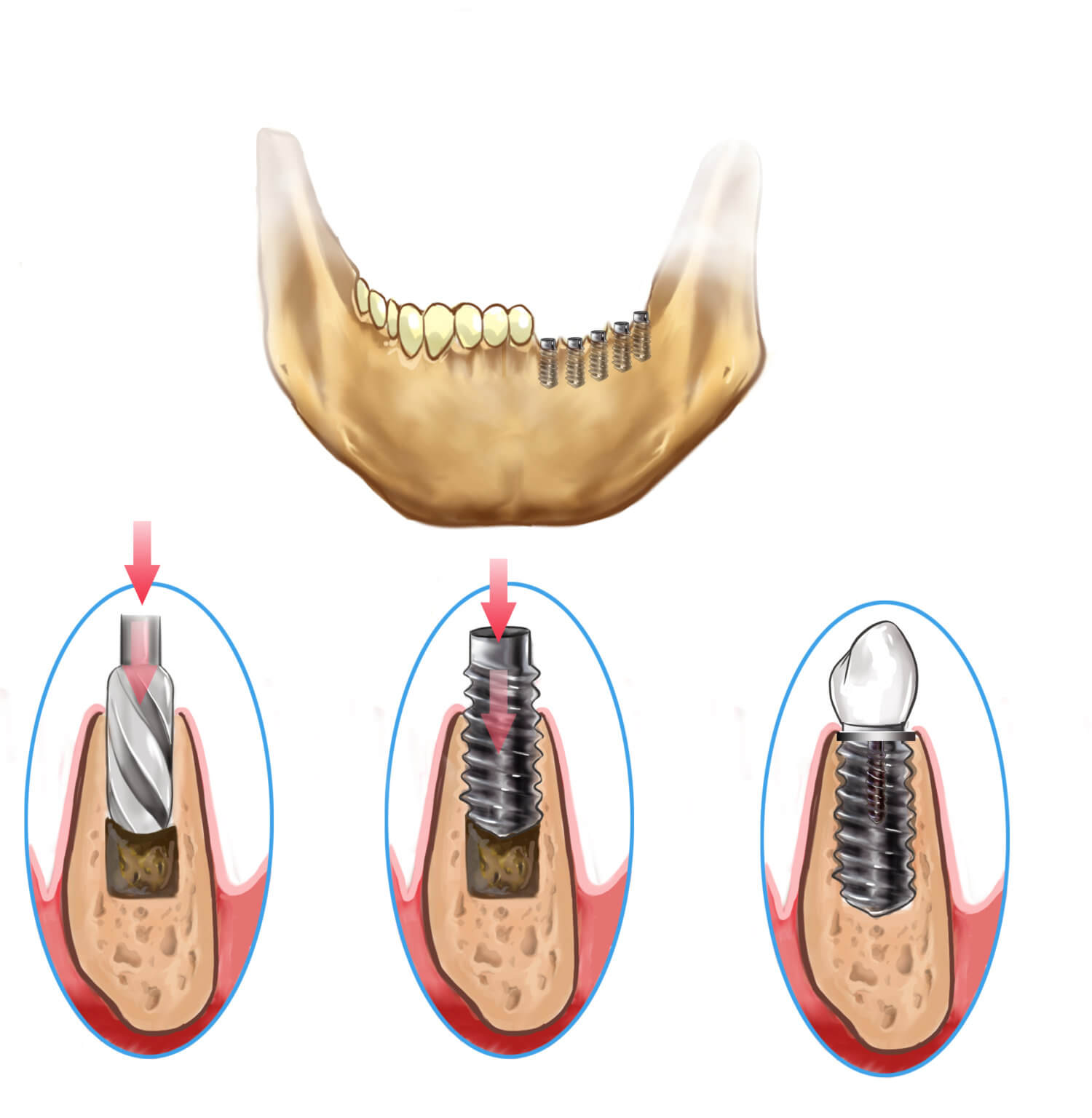 Downtown dental, implants