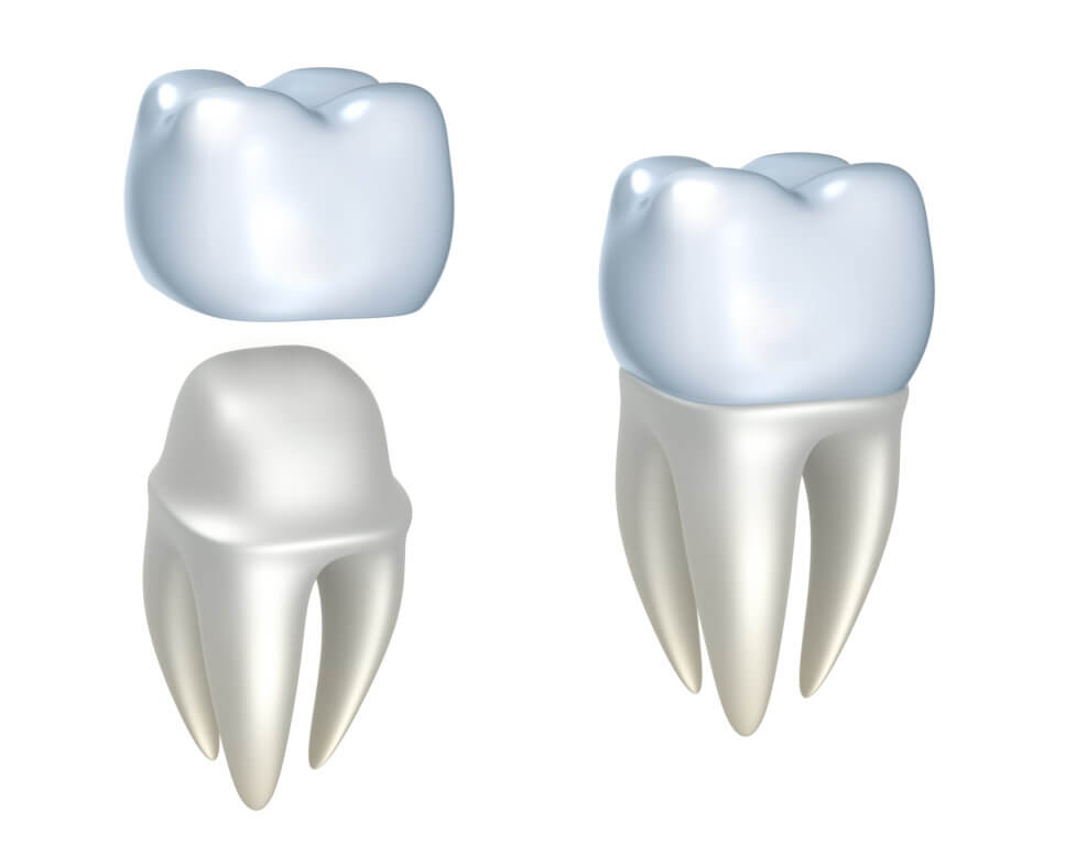 Downtown Dental Crowns